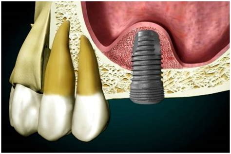 Sinus Augmentation For Dental Implants Lane Ends Dental Practice