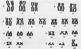 Karyotype Human Chromosomes Homologous Chromosome Normal Karyotypes Denver Syndrome Biology System 46 Hunter Worksheet Pairing Cell Definition Replication After Genes sketch template