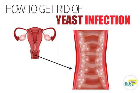 How To Get Rid Of A Yeast Infection And Get Immediate Relief Fab How