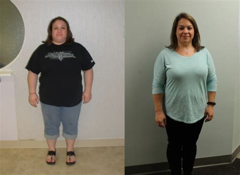 Jennifer S Weight Loss Transformation St Louis Bariatrics