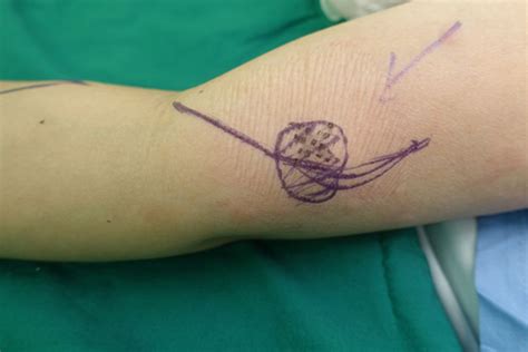 unusual   primary cutaneous melanoma   forearm