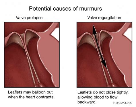 what do you know about heart murmurs mayo clinic news network