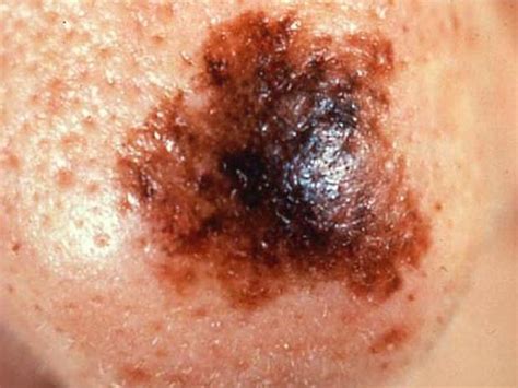 Skin Cancer Or Mole How To Tell Photo 1 Pictures Cbs News