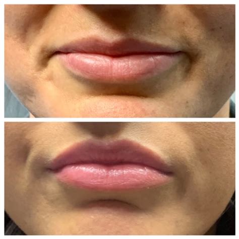 Botox Lip Flip Everything You Need To Know Find A