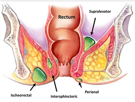 anal abscess colorectal surgeons sydney