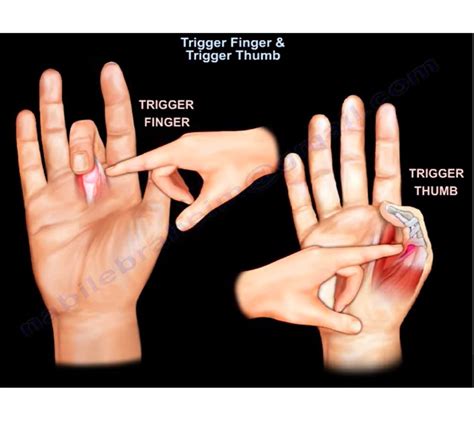 trigger finger  trigger thumb orthopaedicprinciplescom