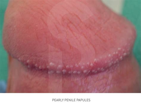 Skinlife Pearly Penile Papules Removal