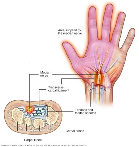 pinched nerve symptoms   mayo clinic