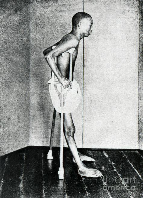 Beriberi Patient Photograph By Us National Library Of Medicine Science