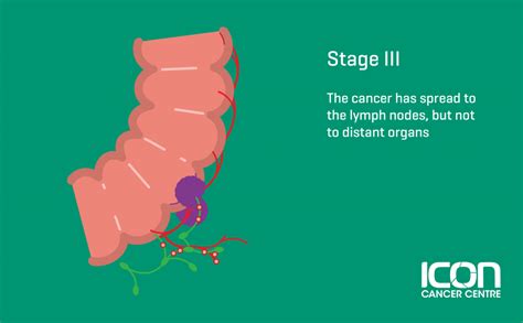 What Is Bowel Cancer Bowel Cancer Explained — Icon Cancer Centre