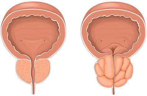 rezum system for treating enlarged prostate