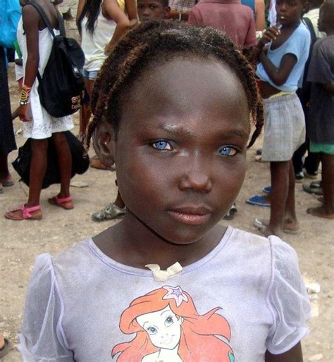 Blacks With Blue Eyes Natural Phenomenon Or Genetic