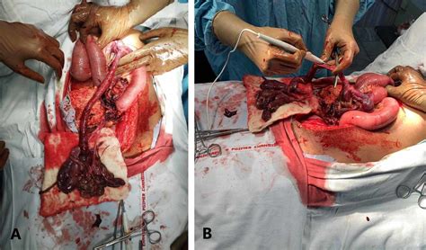 Cureus Rupture Of Unscarred Uterus With Intestinal Prolapse From