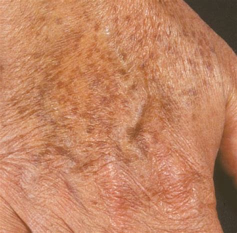 liver spots pictures  treatment removal hubpages