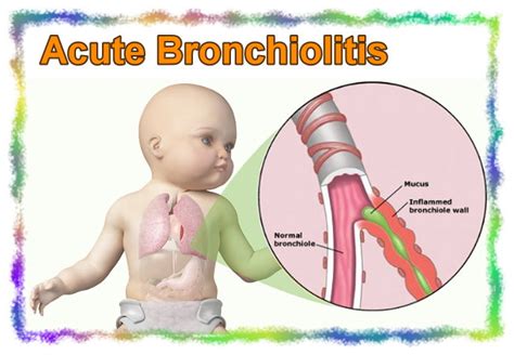 acute bronchiolitis 中文 rhondar