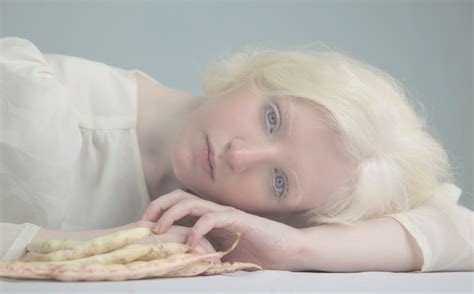 Lets Learn More On Albinism – Hello Sites