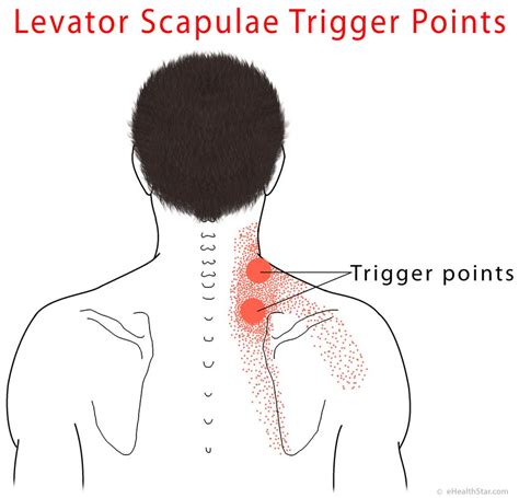 Levator Scapulae Pain Syndrome Trigger Points Stretch