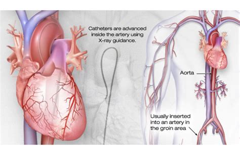 what is cardiac catheterization medical tubing and extrusion