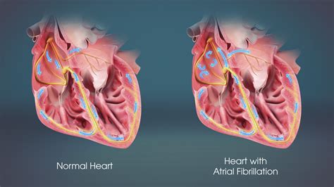 atrial fibrillation related cardiac risks scientific animations
