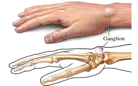 ganglion cyst mississauga  milton chiropractor  physiotherapy