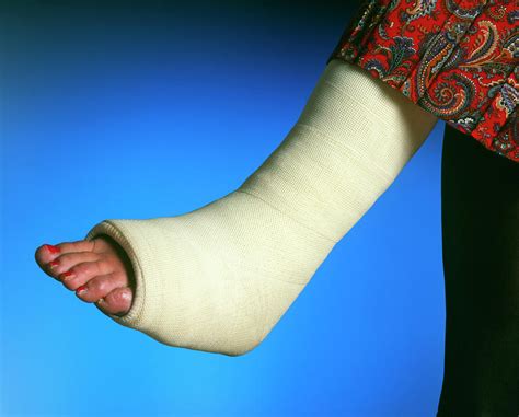 plaster cast   broken leg   woman photograph  simon fraserscience photo library
