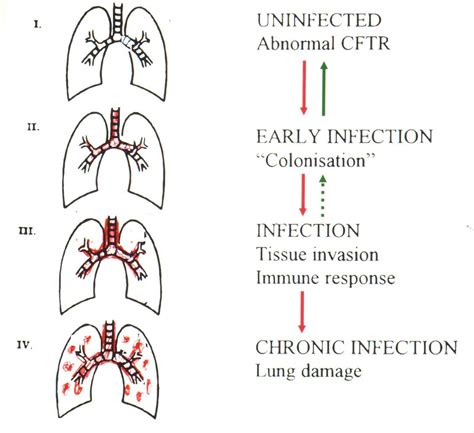 Stages Of Pulmonary Infection – A Paediatricians Life