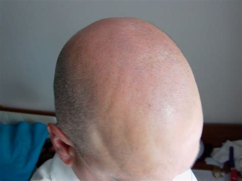 My Bald Head Bald Head 58smooth Flickr