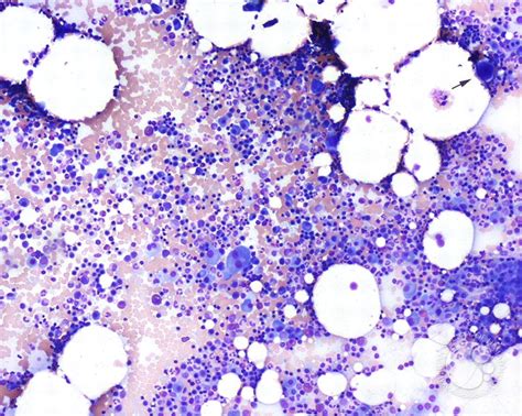 multiple myeloma large plasma cells