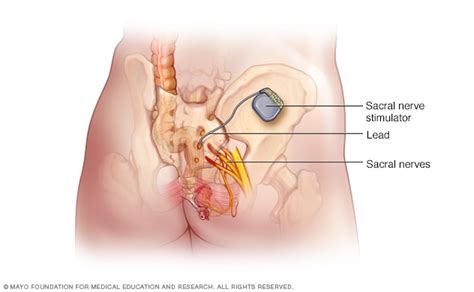 sacral nerve stimulator mayo clinic