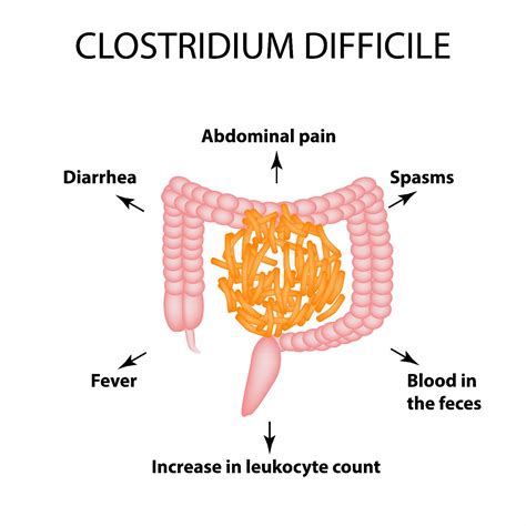 symptoms  clostridium difficile colitis facty health