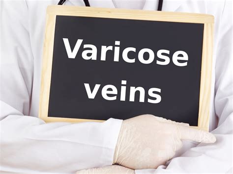 view common   treatment options  varicose veins