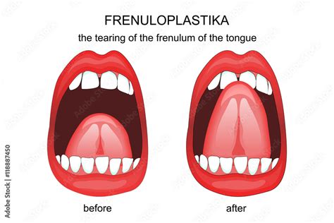 frenuloplastika the tearing of the frenulum of the tongue stock
