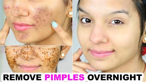 remove pimples overnight 100 success anaysa youtube