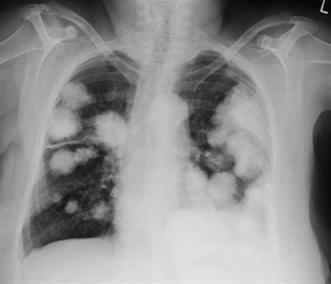 lung metastases  radiology  st vincents university hospital