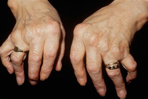 types  arthritis