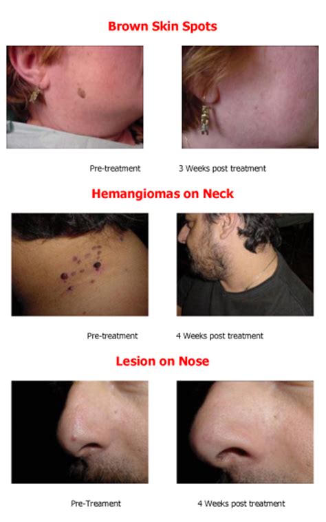 mole removal and skin tag removal windsor ontario coral medical health spa