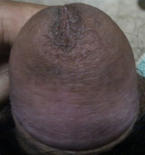 penis head discoloration tubezzz porn photos