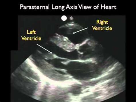 cardiac ultrasound parasternal long axis part  sonosite