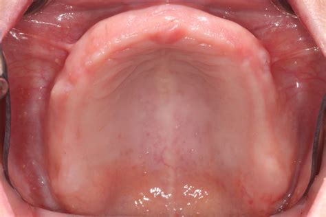 boise idaho prosthodontics maxillary complete denture mandibular