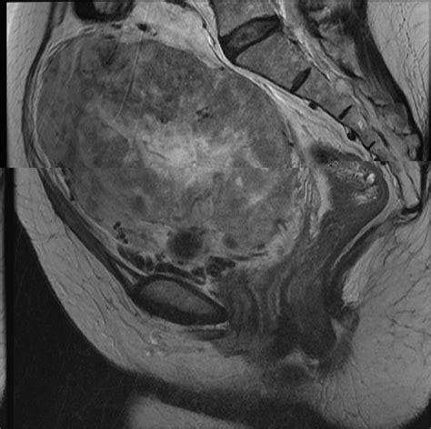 the sagittal t2 weighted fat suppressed image 4800 110 slice