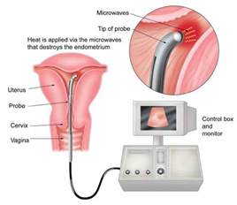 Sex after novasure