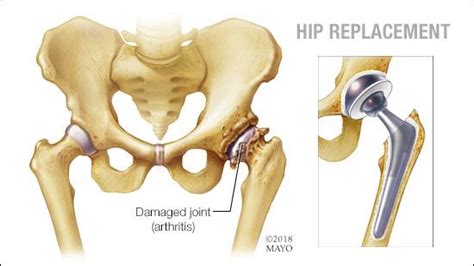 Total Hip Replacement In Aurangabad Cheapest Hip