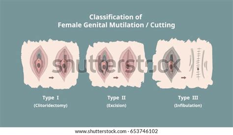 classification female genital mutilation cutting fgmc