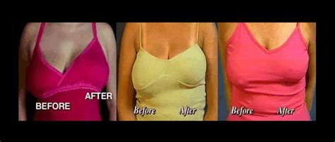 please share how to lift sagging breasts naturally with