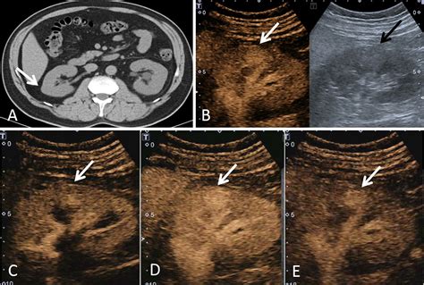 frontiers contrast enhanced ultrasound manifestations  renal masses