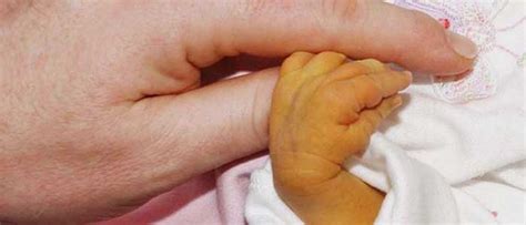 yenidogan bebek sariligi nedir nedenleri belirtileri korunma