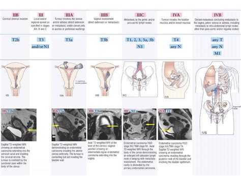 Figo Grade Endometrial Cancer