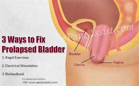 3 Ways To Fix Prolapsed Bladder Bladder Exercises Bladder Bladder