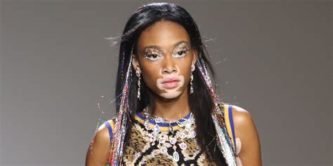 winnie harlow vitiligo windows mode