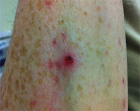 Transverse Myelitis With Rash And Hyperckemia Dermatology Jama